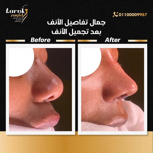 مدة الشفاء من عملية تجميل الأنف